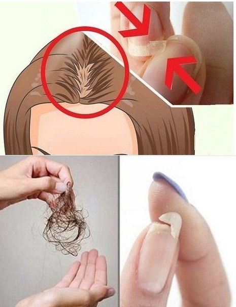 poate cădea părul din cauza ciupercii unghiilor)